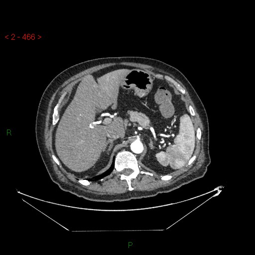 Circumaortic left renal vein and doubled left renal arteries (Radiopaedia 52268-58158 A 2).jpg