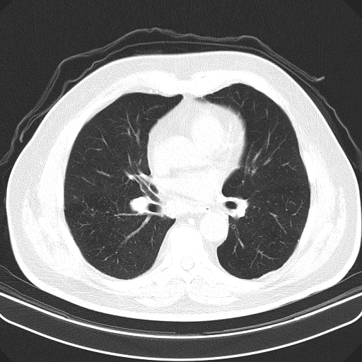 File:Classic complicated silicosis (Radiopaedia 49720-54961 Axial lung window 30).jpg