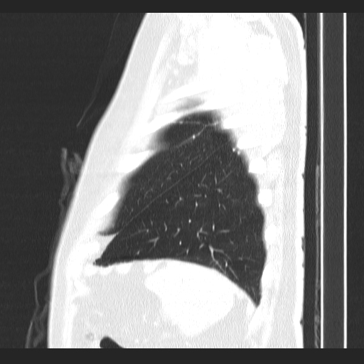 File:Classic complicated silicosis (Radiopaedia 49720-54961 Sagittal lung window 8).jpg