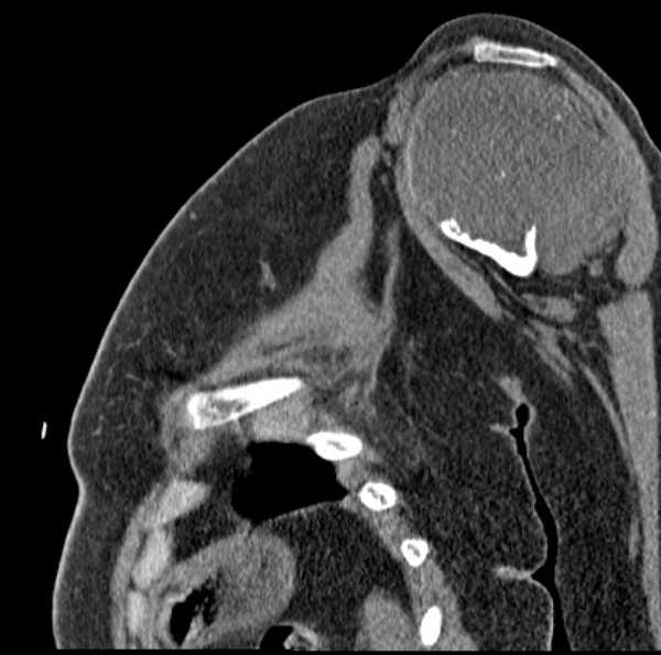 Clear cell chondrosarcoma - humerus (Radiopaedia 63104-71612 D 27).jpg