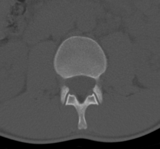 Clear cell meningoma - lumbar spine (Radiopaedia 60116-67691 Axial bone window 23).png