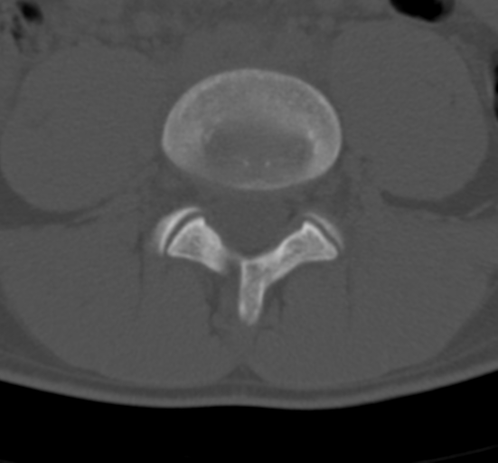Clear cell meningoma - lumbar spine (Radiopaedia 60116-67691 Axial bone window 54).png