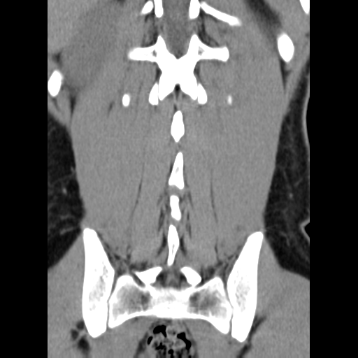 Clear cell meningoma - lumbar spine (Radiopaedia 60116-67691 Axial non-contrast 1).png