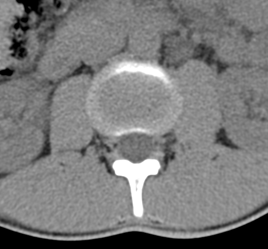 Clear cell meningoma - lumbar spine (Radiopaedia 60116-67691 Axial non-contrast 20).png
