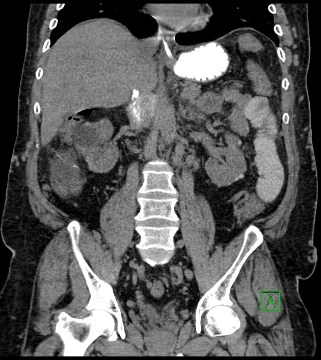 Closed-loop small bowel obstruction-internal hernia (Radiopaedia 78439-91096 Coronal non-contrast 60).jpg