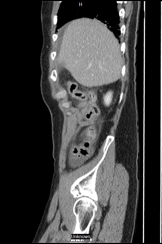 Closed loop bowel obstruction and ischemia (Radiopaedia 86959-103180 C 58).jpg