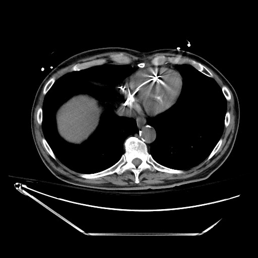File:Closed loop obstruction due to adhesive band, resulting in small bowel ischemia and resection (Radiopaedia 83835-99023 Axial non-contrast 17).jpg