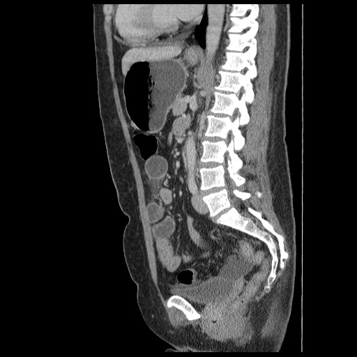 Closed loop small bowel obstruction (Radiopaedia 65403-74451 C 58).jpg
