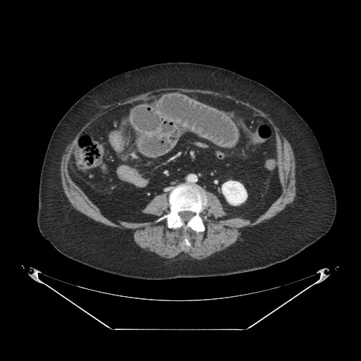 Closed loop small bowel obstruction - internal hernia (Radiopaedia 65402-74450 A 71).jpg
