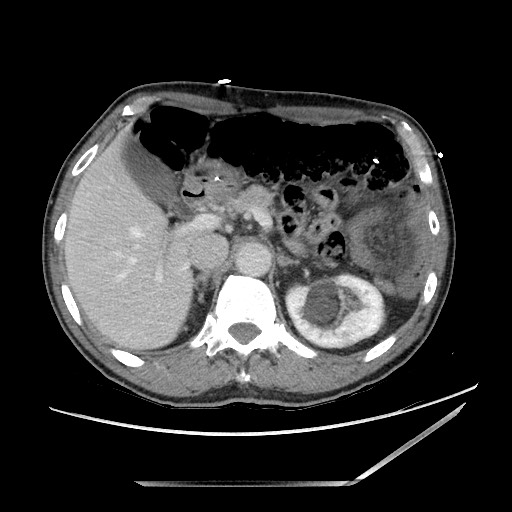 Closed loop small bowel obstruction - omental adhesion causing "internal hernia" (Radiopaedia 85129-100682 A 42).jpg