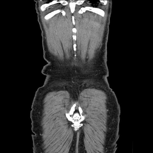 File:Closed loop small bowel obstruction - omental adhesion causing "internal hernia" (Radiopaedia 85129-100682 B 119).jpg