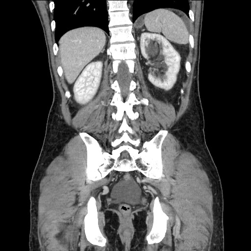 Closed loop small bowel obstruction - omental adhesion causing "internal hernia" (Radiopaedia 85129-100682 B 96).jpg