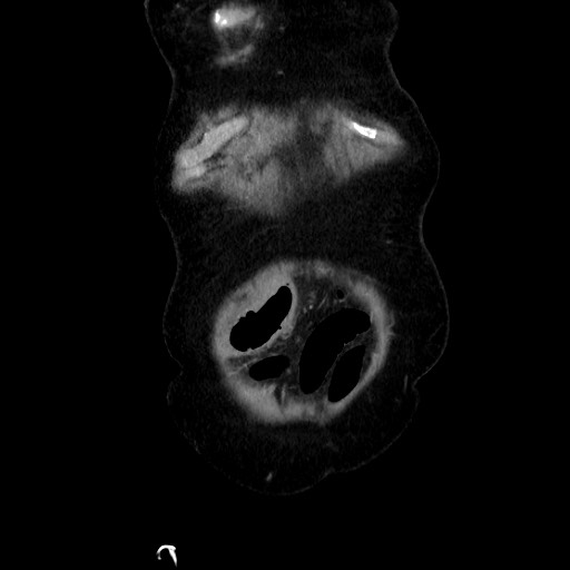 Closed loop small bowel obstruction due to adhesive band, with intramural hemorrhage and ischemia (Radiopaedia 83831-99017 C 18).jpg