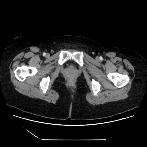 File:Closed loop small bowel obstruction due to adhesive bands - early and late images (Radiopaedia 83830-99014 A 160).jpg