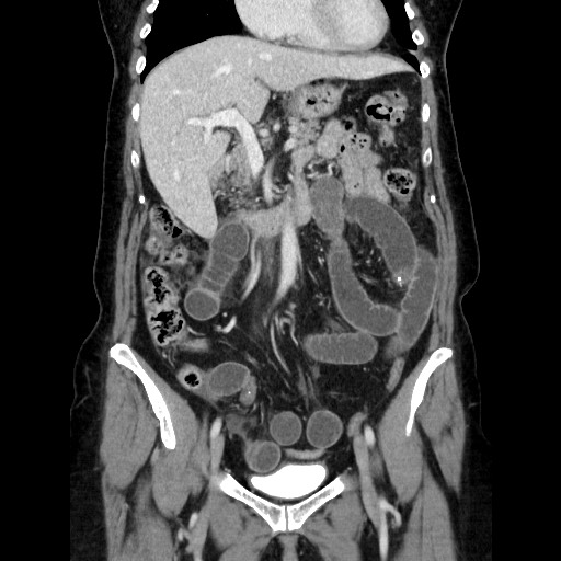 File:Closed loop small bowel obstruction due to adhesive bands - early and late images (Radiopaedia 83830-99015 B 52).jpg