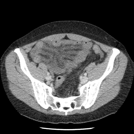 Closed loop small bowel obstruction due to trans-omental herniation (Radiopaedia 35593-37109 A 67).jpg