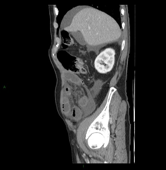 Closed loop small bowel obstruction with ischemia (Radiopaedia 84180-99456 C 24).jpg