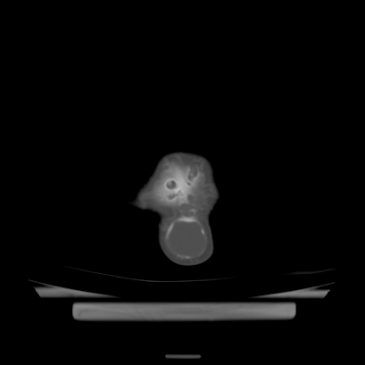 Cloverleaf skull (Radiopaedia 91901-109710 Axial bone window 142).jpg
