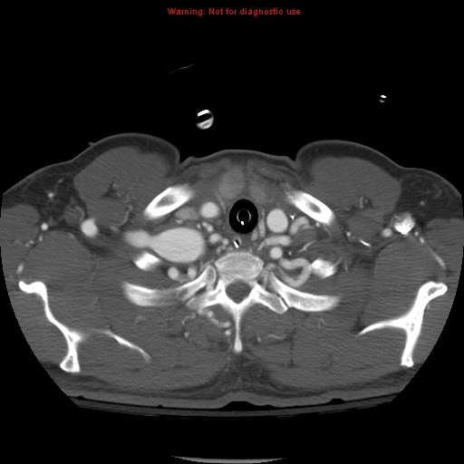 File:Coarctation of the aorta (Radiopaedia 8681-9490 B 10).jpg