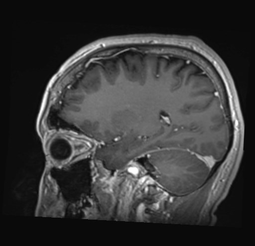 Cochlear incomplete partition type III associated with hypothalamic hamartoma (Radiopaedia 88756-105498 Sagittal T1 C+ 36).jpg