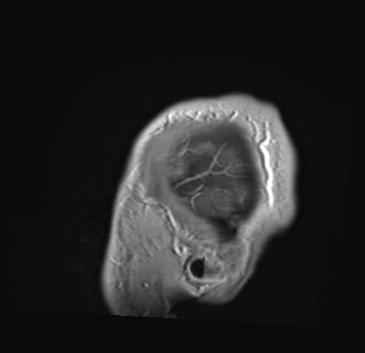 File:Cochlear incomplete partition type III associated with hypothalamic hamartoma (Radiopaedia 88756-105498 Sagittal T1 C+ 51).jpg