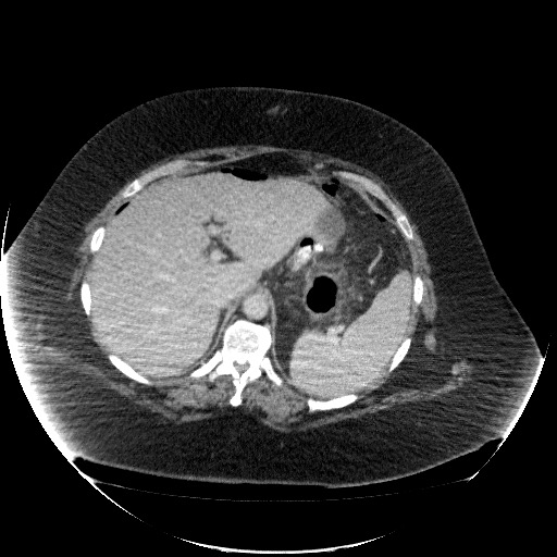 File:Collection due to leak after sleeve gastrectomy (Radiopaedia 55504-61972 A 22).jpg