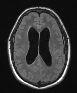 File:Colloid cyst (Radiopaedia 44510-48181 Axial FLAIR 18).png