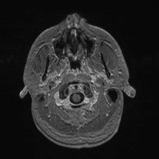 Colloid cyst (Radiopaedia 44510-48181 Axial T1 C+ 22).png