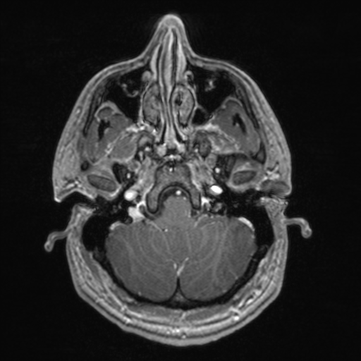File:Colloid cyst (Radiopaedia 44510-48181 Axial T1 C+ 44).png