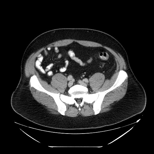 Colocolic intussusception due to lipoma (Radiopaedia 73712-84508 A 85).jpg