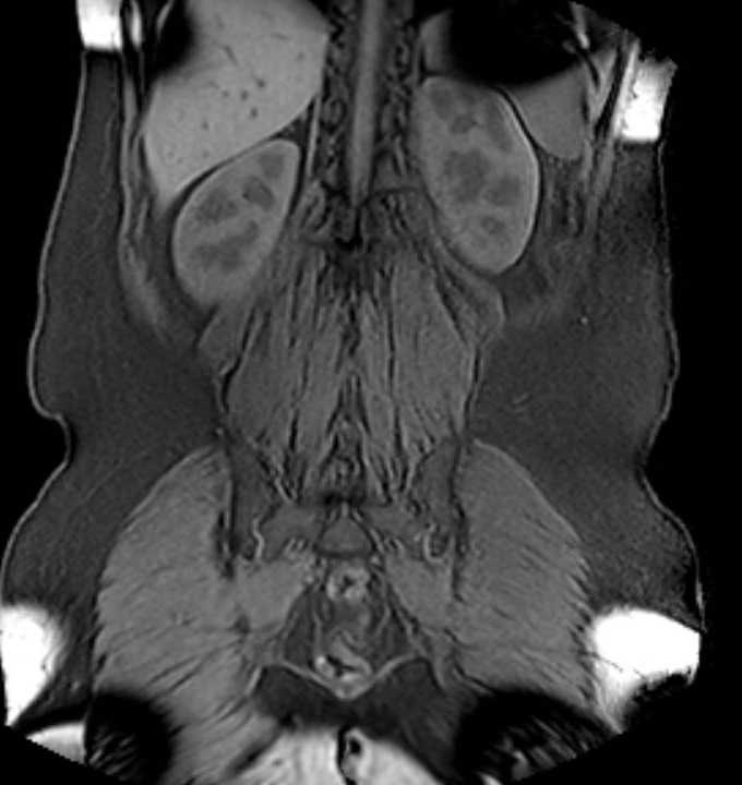 Colon adenocarcinoma with Krukenberg tumors, advanced pregnancy (Radiopaedia 67279-76645 E 76).jpg