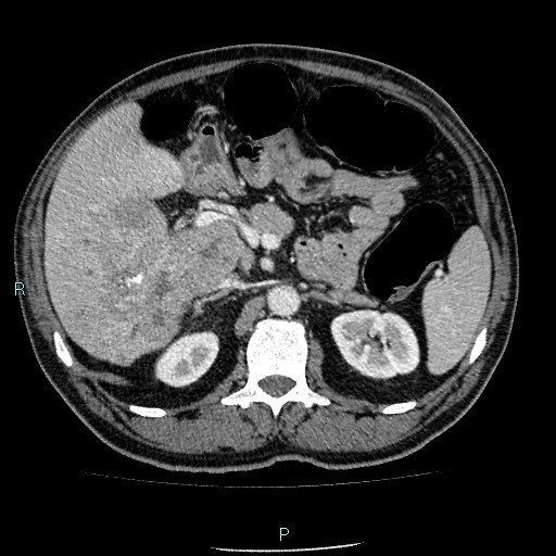 Colon adenocarcinoma with calcific liver metastasis (Radiopaedia 55745-62300 B 13).jpg