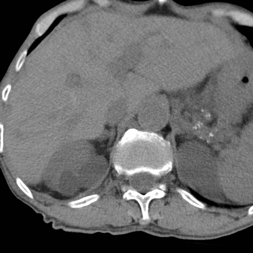 Colon cancer with calcified liver metastasis (Radiopaedia 74423-85309 Axial non-contrast 23).jpg
