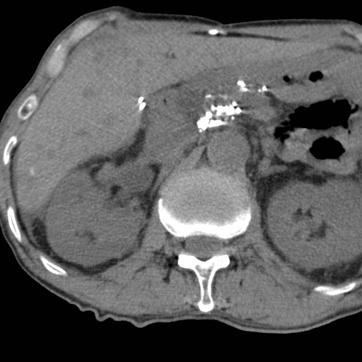 Colon cancer with calcified liver metastasis (Radiopaedia 74423-85309 Axial non-contrast 33).jpg