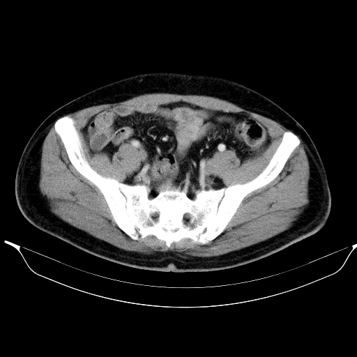 Colonic lipoma with colo-colic intussusception (Radiopaedia 58944-66200 A 52).jpg