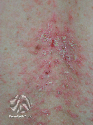 File:Darier disease on the mid-back (DermNet NZ scaly-darier1).jpg