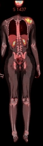 File:Ewing's sarcoma of scapula (Radiopaedia 60692-68451 PET-CT whole body scan 2).jpg