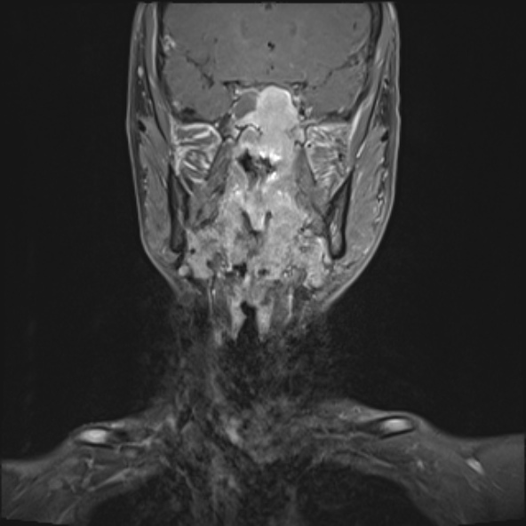 Nasopharyngeal carcinoma with skull base invasion (Radiopaedia 53415-59485 E 24).jpg