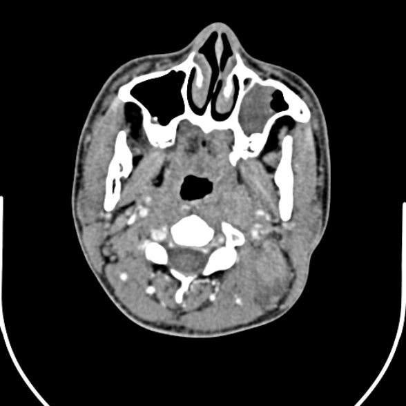 Nasopharyngeal carcinoma with skull base invasion (Radiopaedia 53415-59705 A 72).jpg
