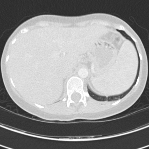 Necrobiotic pulmonary nodules - Crohn disease (Radiopaedia 20723-20631 Axial lung window 134).jpg