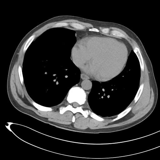 File:Necrotizing pancreatitis with acute necrotic collections (Radiopaedia 38829-41012 Axial non-contrast 3).png