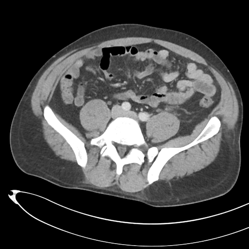 File:Necrotizing pancreatitis with acute necrotic collections (Radiopaedia 38829-41012 B 56).png