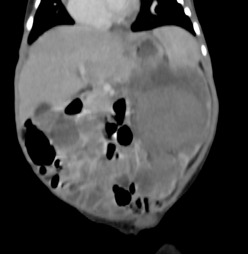 Nephroblastomatosis (Radiopaedia 71294-81607 B 164).jpg