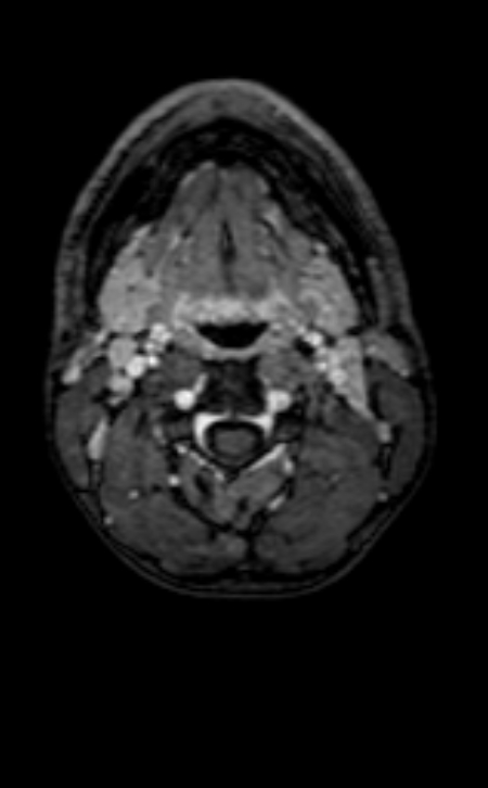 Neuro-Behçet disease (Radiopaedia 90112-107294 Axial T1 C+ 248).jpg