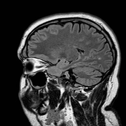 File:Neuro-Behcet's disease (Radiopaedia 21557-21506 Sagittal FLAIR 11).jpg