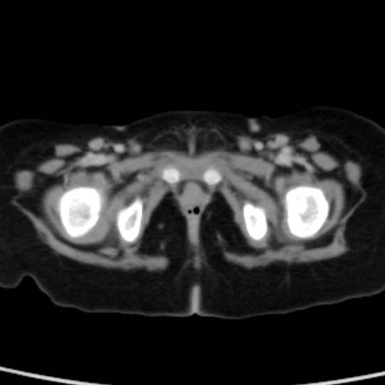Neuroblastoma with skull metastases (Radiopaedia 30326-30960 C 63).jpg