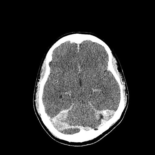 File:Neurofibromatosis type 2 (Radiopaedia 25389-25637 Axial C+ 40).jpg