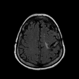 File:Neurofibromatosis type 2 (Radiopaedia 8713-9518 Axial FLAIR 6).jpg