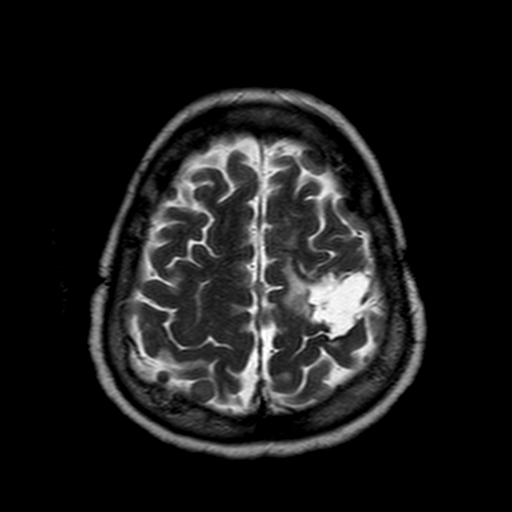 File:Neurofibromatosis type 2 (Radiopaedia 8713-9518 Axial T2 5).jpg