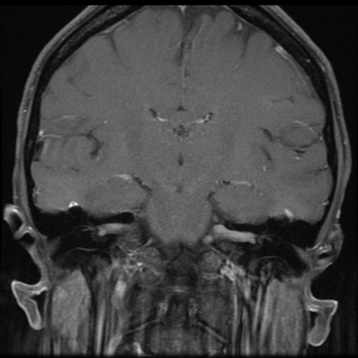 File:Neurofibromatosis type 2 - bilateral acoustic neuromata (Radiopaedia 40060-42566 Coronal T1 C+ 6).png